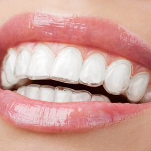 Invisalign Los Angeles  Invisible Braces - Museum Dental Center